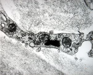 F,79y. | jejunum - amyloidosis